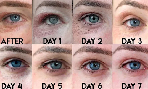 plasma iq pen eye wrinkle treatment before after mississauga oakville toronto